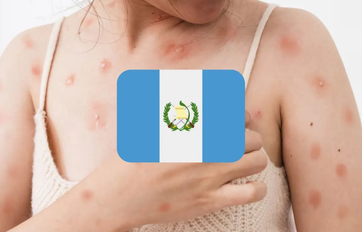 Alerta Epidemiológica Guate: Variante Peligrosa de Viruela de mono en Auge
